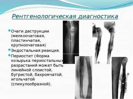 Периостальная реакция
