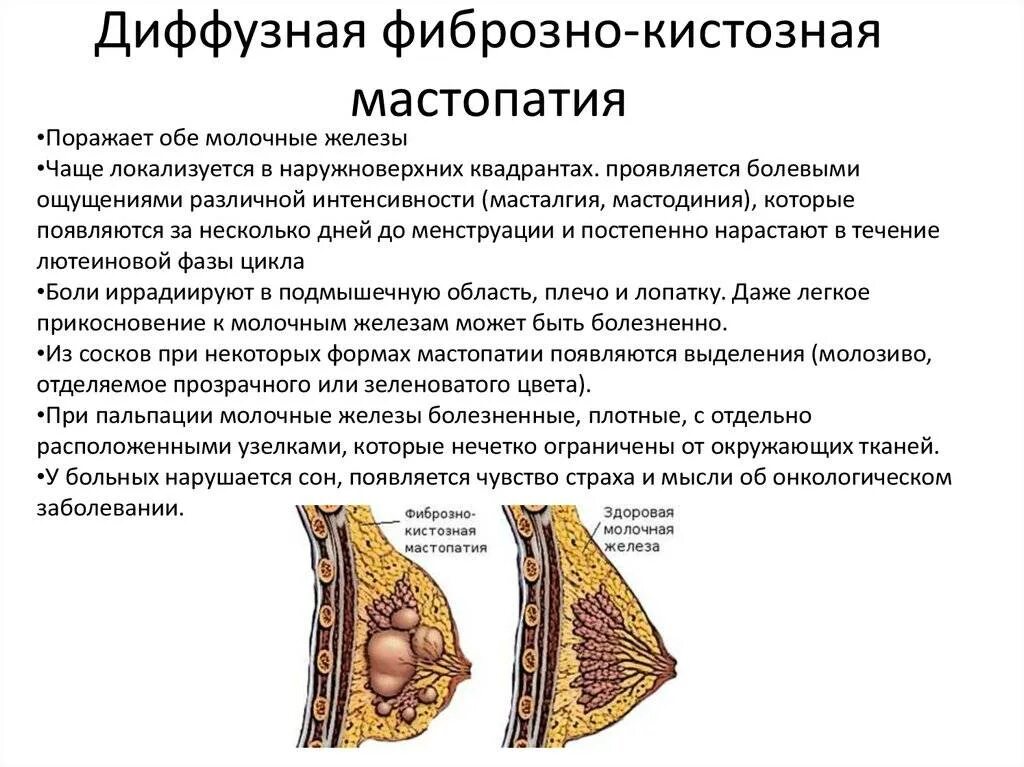 Фиброзно-кистозная мастопатия симпто. Диффузно-фиброзная мастопатия молочной железы. Диффузная кистозная мастопатия. Фиброзно-кистозная мастопатия молочных желез симптомы. Двухсторонняя диффузная