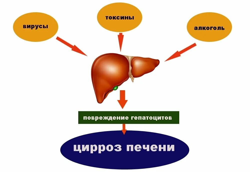 Заболевание печен. Схема развития цирроза печени. Схема лечения цирроза печени. Цирроз печени схема печени.