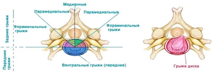 Задняя медианная грыжа