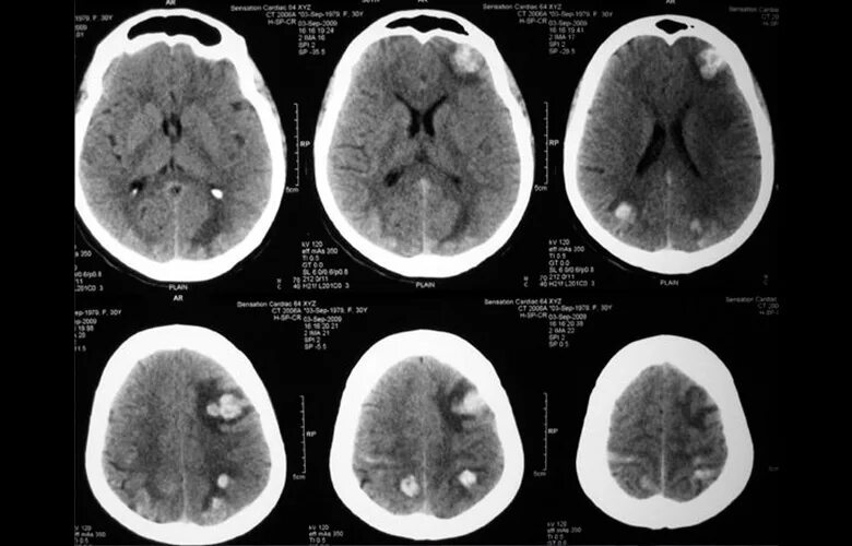 Метастазы меланомы в головной мозг кт. Метастазы меланомы в головной мозг мрт. Метастазы головного мозга кт.