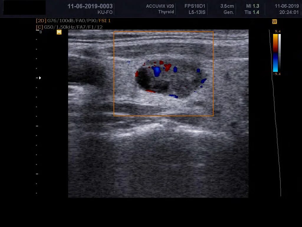 Ультразвуковая анатомия щитовидной железы. Кальцинат щитовидной железы узи. Узел щитовидной железы описание. Причины узлов щитовидной железы. Доброкачественные узлы щитовидной.