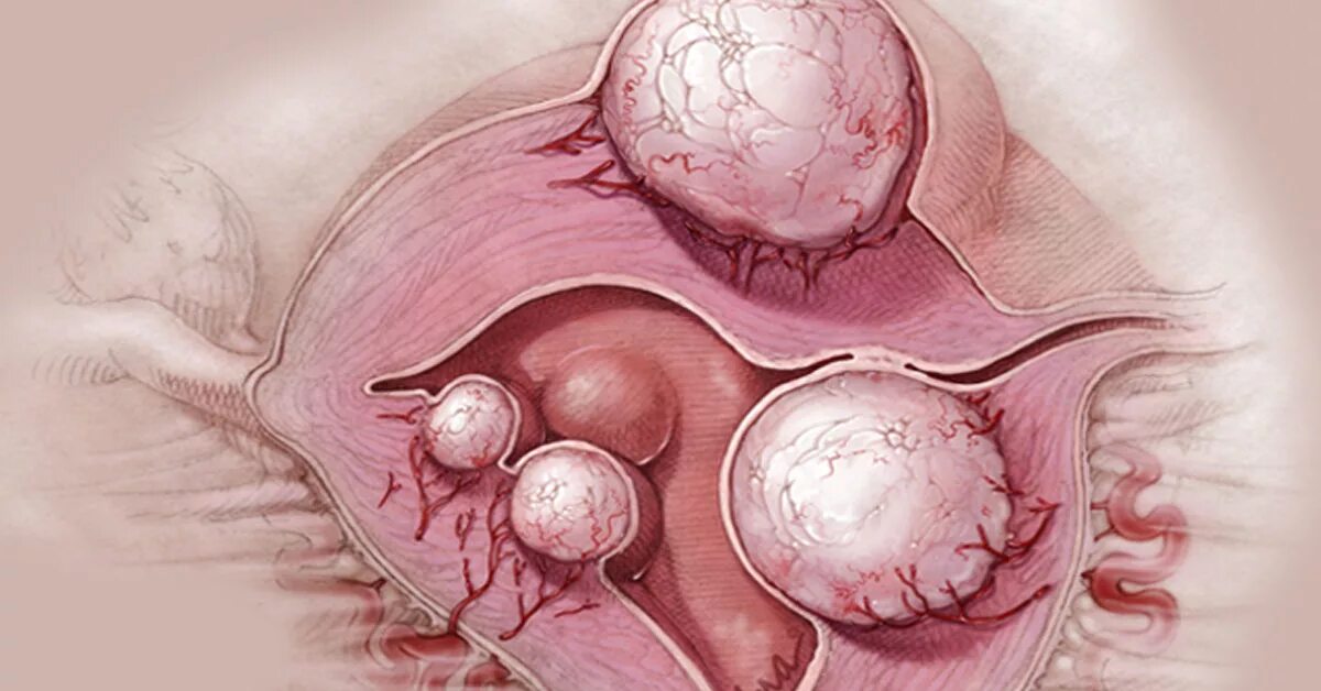 Эндометриоидная киста яичника эндометриоидная киста. Эндометриоз киста яичника. Эндометриалтные опухоли яичников.