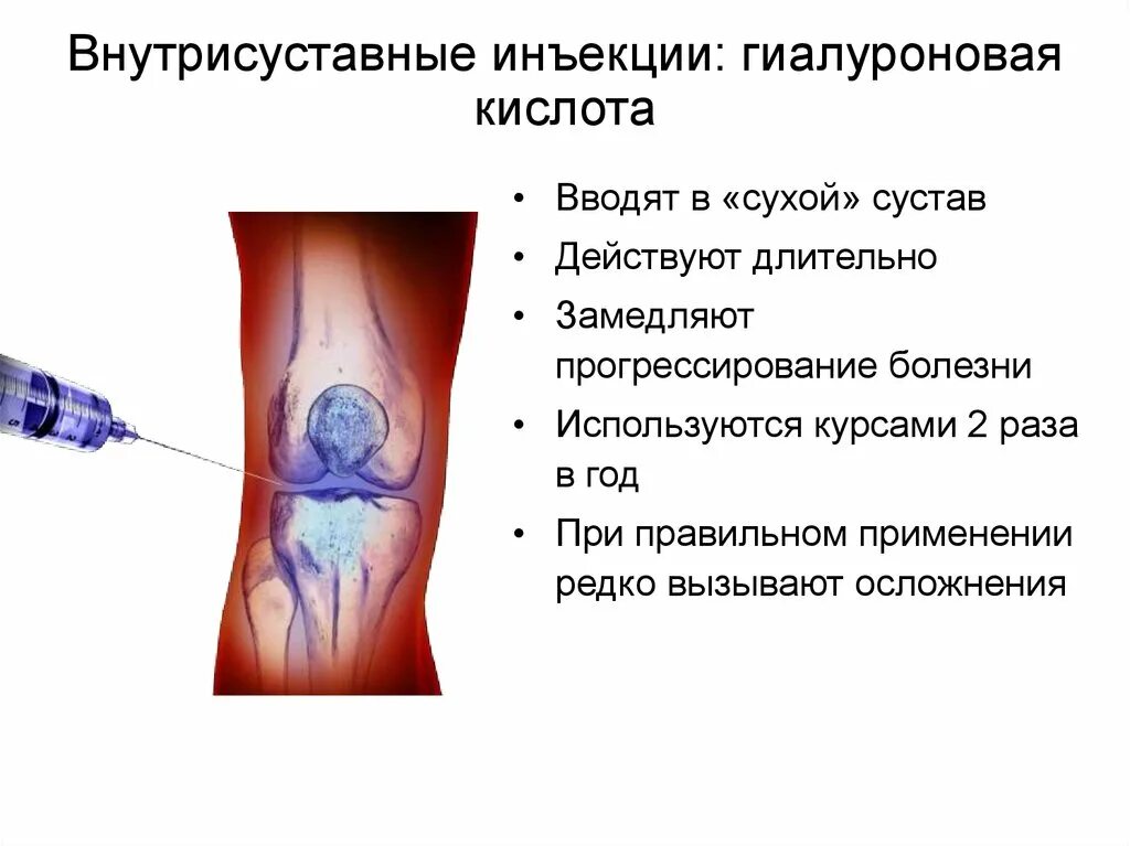 Гормон инъекция. Препараты для внутрисуставного введения. Внутрисуставные инъекции. Внутрисуставной укол гормональный. Гормоны для внутрисуставного введения.