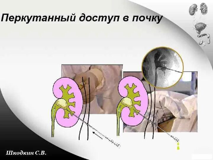 Перкутанный путь заражения. Перкутанная литотрипсия камней почек. Нефролитотрипсия перкутанная лазерная. Перкутанная чрескожная литотрипсия. Перкутанный.