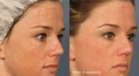 Лазерная шлифовка кожи skinlift