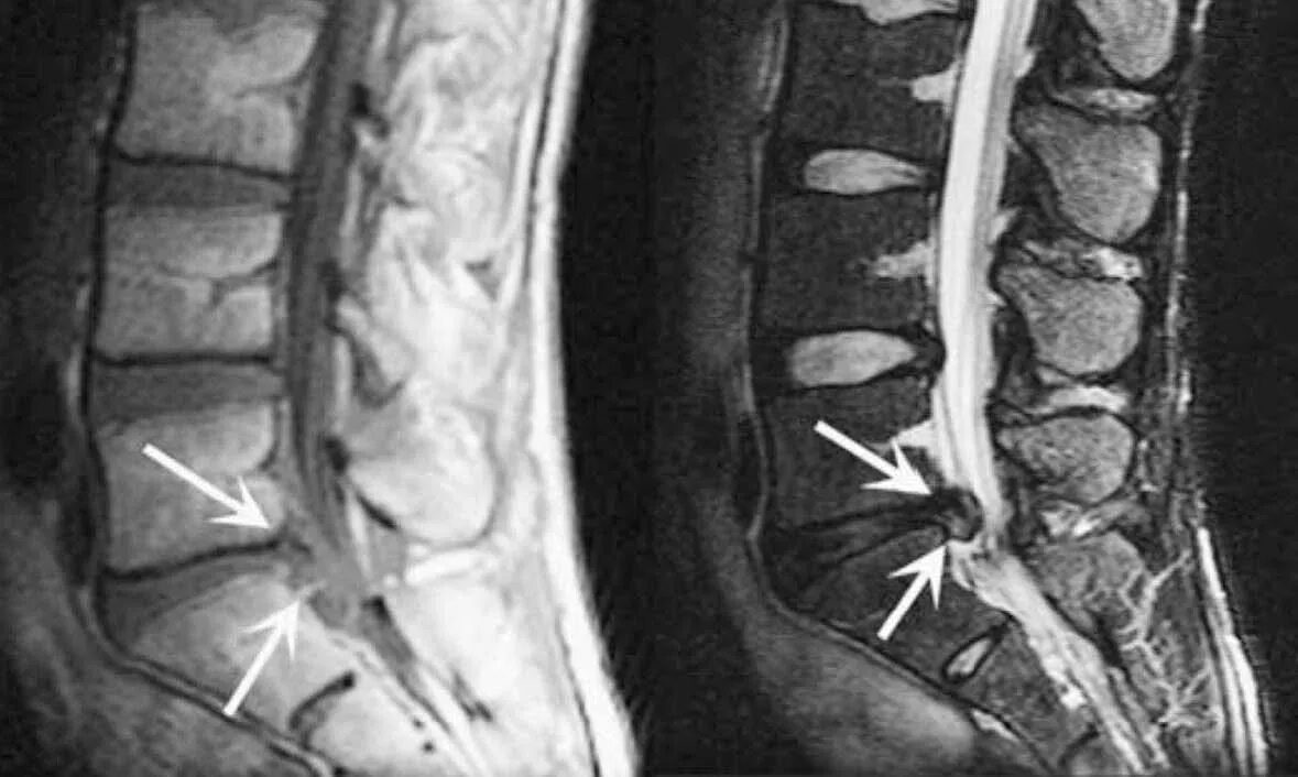 Остеохондроз поясничного отдела l5 s1. Мрт протрузии позвонков l5 s1. Протрузии диска l5-s1. Протрузия дисков позвоночника l4 l5. Диски позвоночника l3-4, l5-s1.