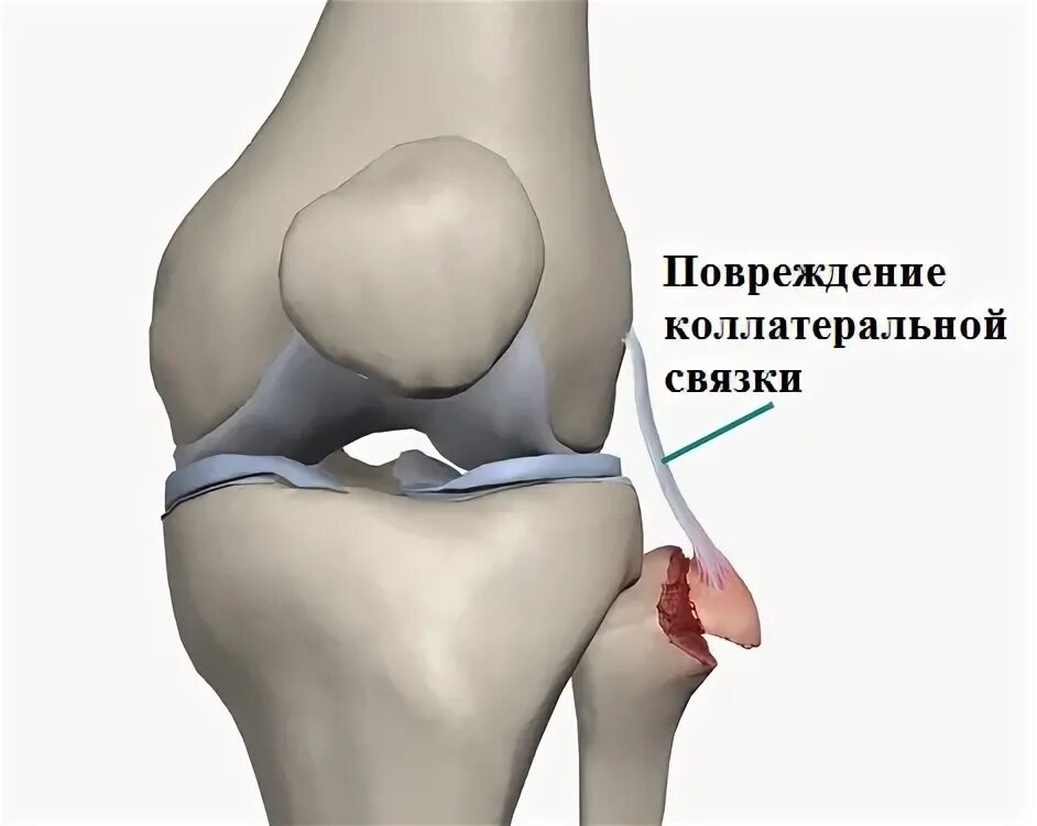 Дегенеративные изменения крестообразных связок коленного сустава