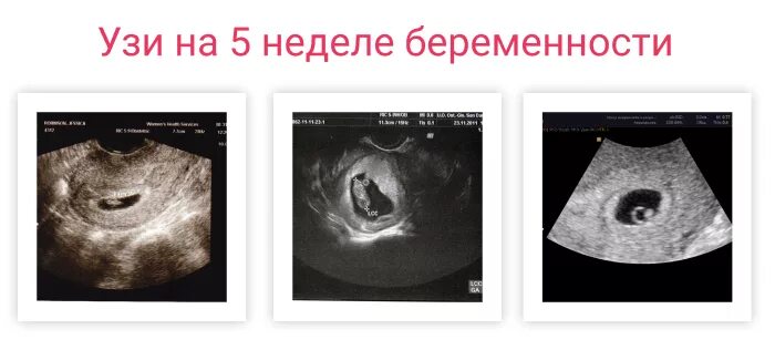 Аппетит на 5 неделе. Как выглядит эмбрион в 5 недель на УЗИ. Как выглядит плод на УЗИ на 5 неделе. УЗИ на 5 акушерской неделе беременности. УЗИ на 5 неделе беременности от зачатия.