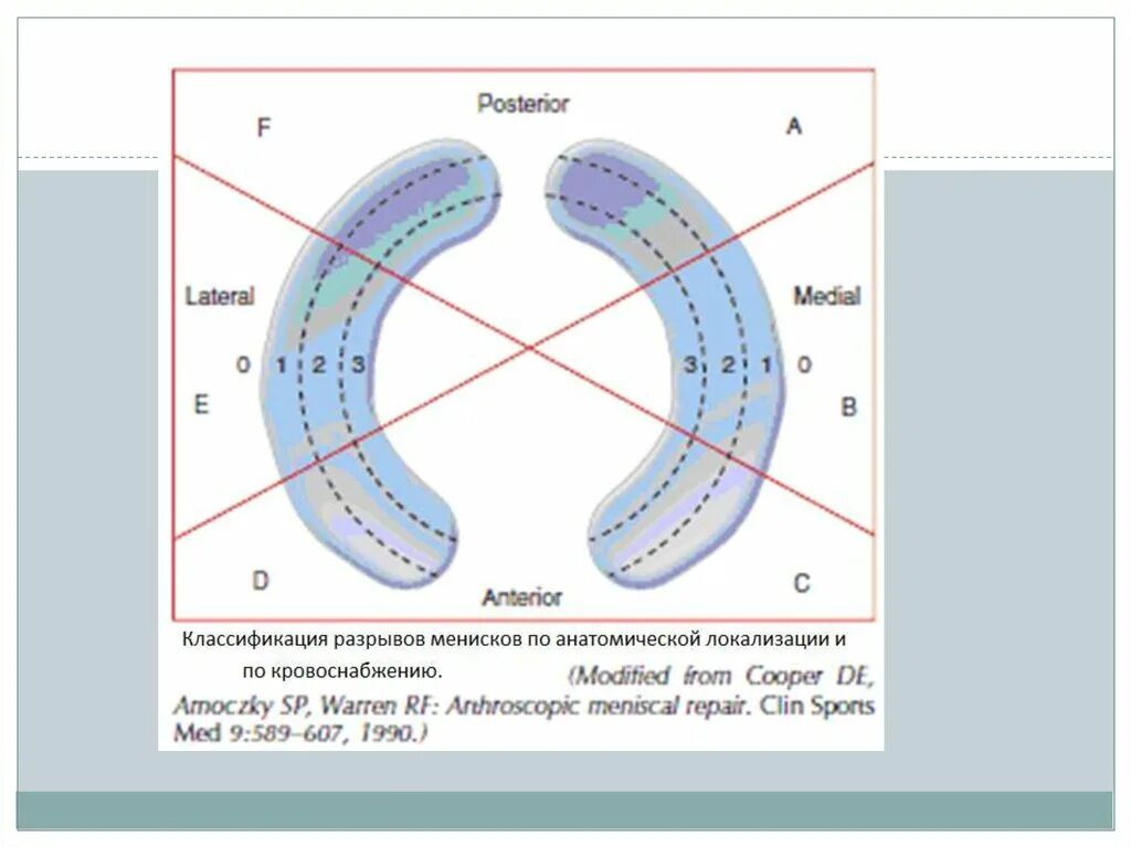 Типы разрывов мениска. Разрыв мениска мрт классификация. Классификация разрывов мениска. Классификация повреждения менисков. Разрывы менисков классификация.