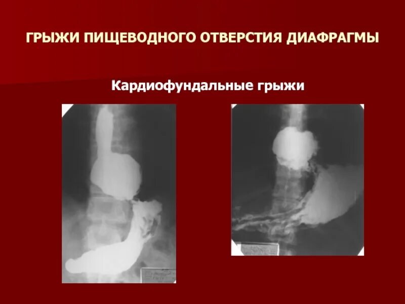 Грыжа пищеводного отверстия причины. Грыжа пищеводного отверстия диафрагмы. Грыжа пищеводного отверстия симптомы. Фундальная грыжа пищеводного отверстия. Кардиофундальная грыжа пищеводного отверстия.