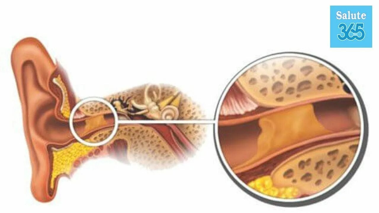 Atrial patch alone treats otitis media Vinmec