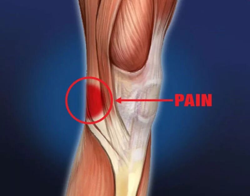 Разрыв крестообразной связки коленного сустава рентген. Четырехглавая мышца коленного сустава. Повреждения коленных связок симптомы. Подколенная связка коленного сустава. Лигаментоз связок коленного сустава.