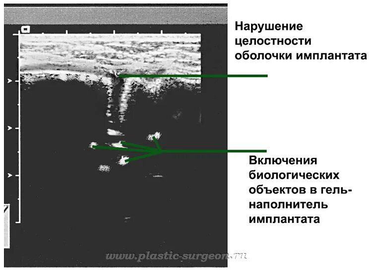 Целостность имплантов. Целостность имплантов. Несъемный протез на 6 имплантах. Дентальная имплантация. Имплантация neodent.