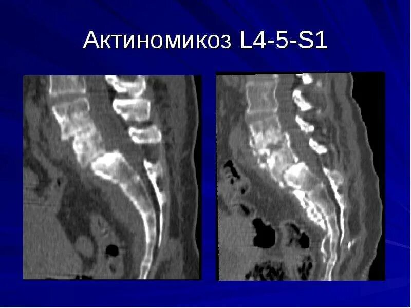 Актиномикоз это. Торакальный актиномикоз. актиномикоз костей и суставов. актиномикоз позвоночника.