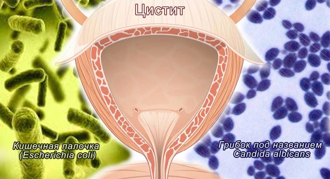 Кишечная палочка цистит. Воспаление мочевого пузыря.