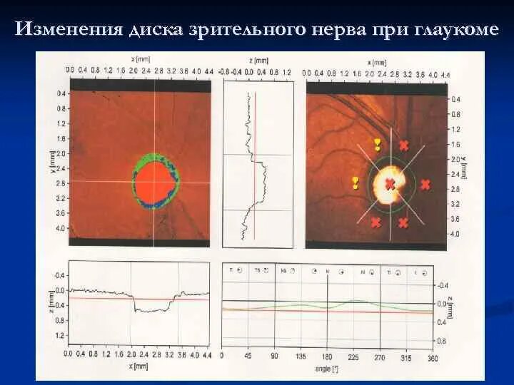 Зрительный нерв при глаукоме. Изменения диска зрительного нерва при глаукоме. Площадь диска зрительного нерва норма. Экскавация диска зрительного нерва э/д. Экскавация диска зрительного нерва при глаукоме 1 стадии.