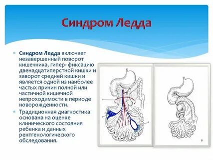 Аэроколия что это
