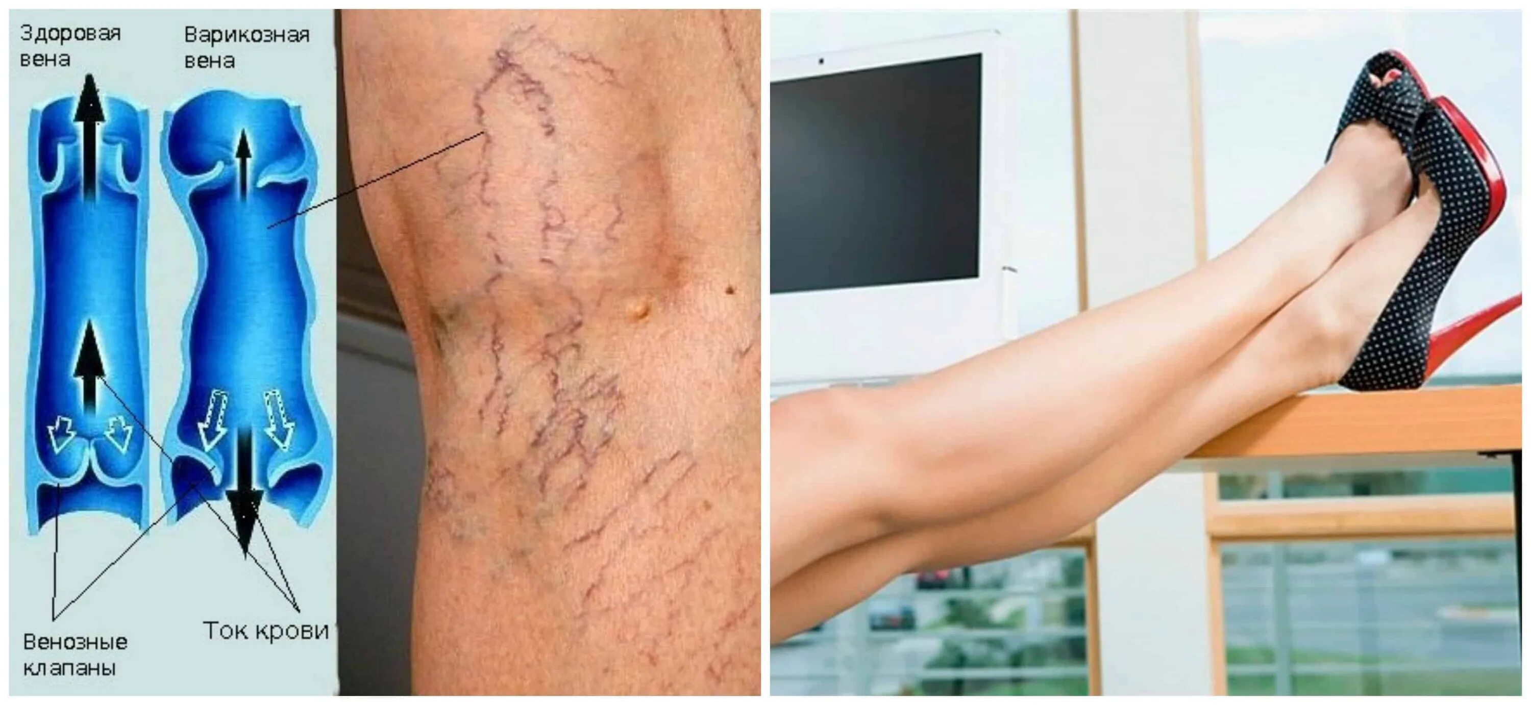 Телеангиоэктазии варикоз. Как называется варикоз ног. Как называется варикоз ног. Варикоз телеангиэктазии. Флебит тромбофлебит нижних.