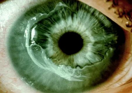 Eye 1