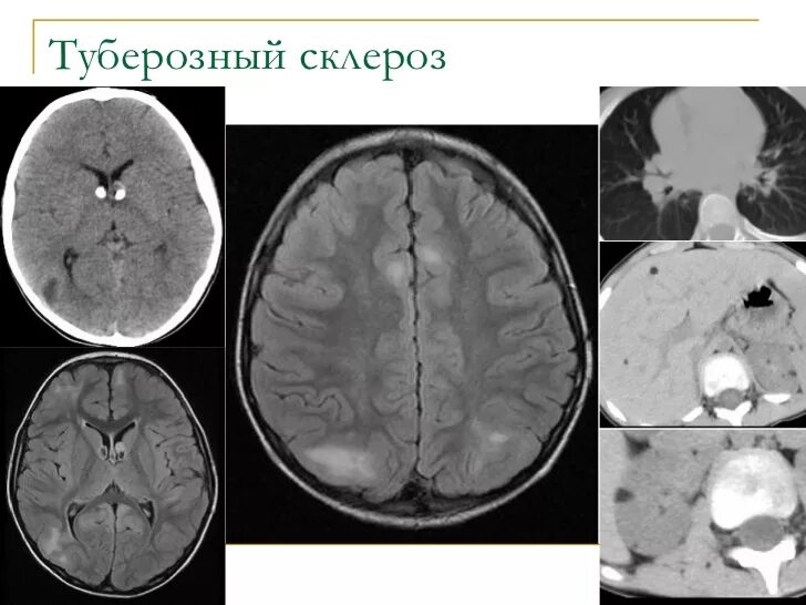 Туберкулезный склероз. Туберозный склероз головного мозга мрт. ангиофибромы туберозный склероз. туберозный склероз кт головного мозга. туберозный склероз головного мозга у детей мрт.