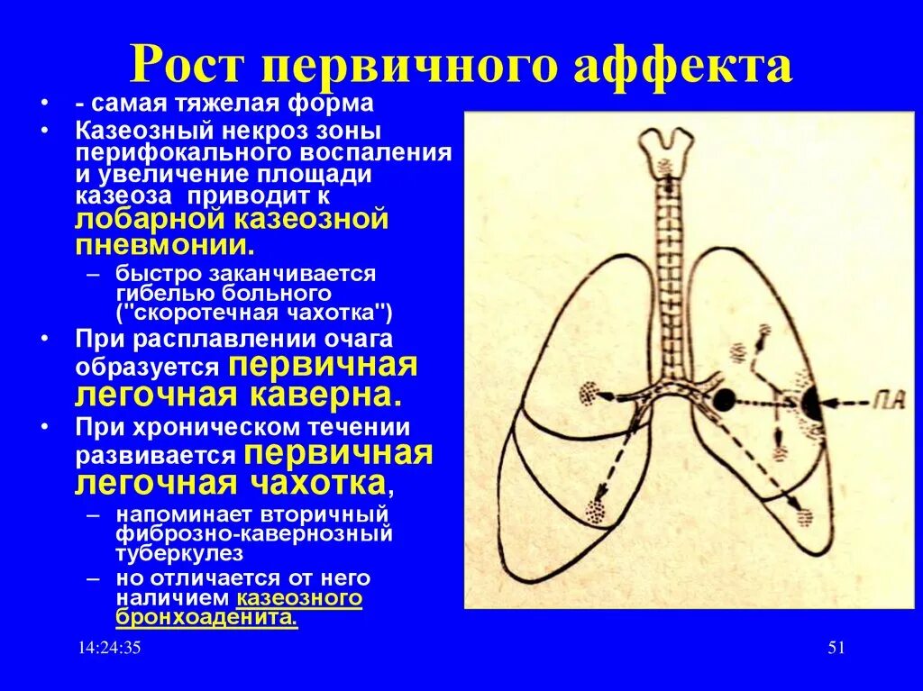 Врожденный туберкулез. Рост первичного аффекта при туберкулезе. Рост первичного аффекта. Патогенез фиброзно-кавернозного туберкулеза.