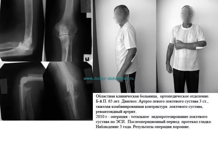 Локтевой сустав инвалидность. Контрактура локтевого сустава рентген описание. степени артроза локтевого сустава рентген. артроз локтевого сустава 1 степени рентген. артроз локтевого сустава рентген.
