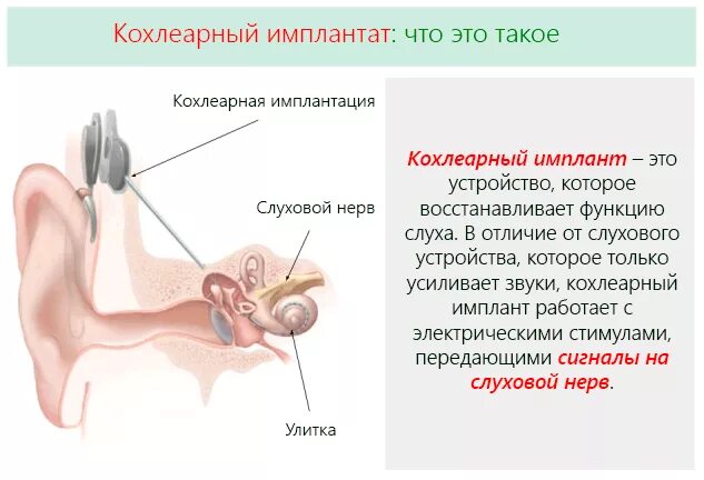 Кохлеарный имплантат принцип действия. Кохлеарная имплантация операция. Тугоухость кохлеарная имплантация. Кохлеарный имплант слух. Операция на ухо на слух