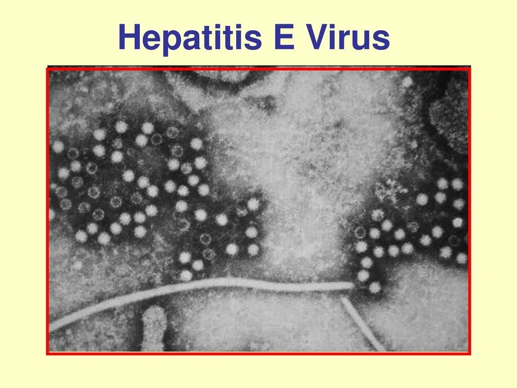 The is caused by a virus. Hepatitis e virus. e вирус. гепатит е микробиология. гепатит е картинки.