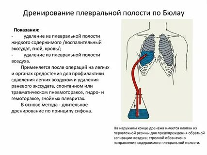 Зачем трубки после операции