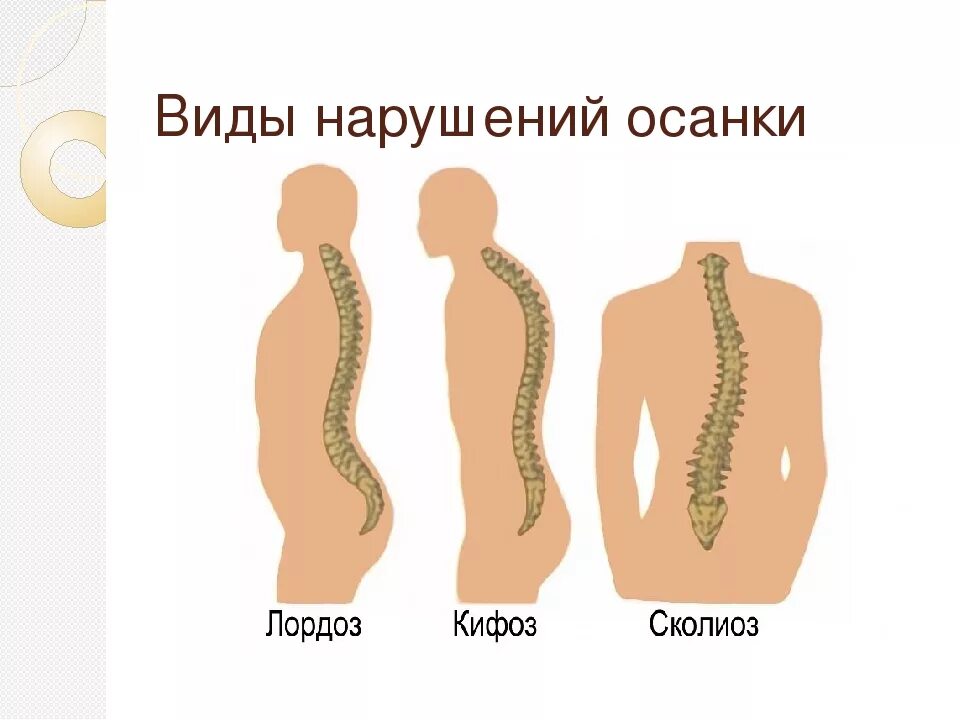 Патологический кифоз и лордоз. Физиологический лордоз и кифоз позвоночника. Шейный лордоз кифоз. Кифоз лордоз и сколиоз позвоночника.