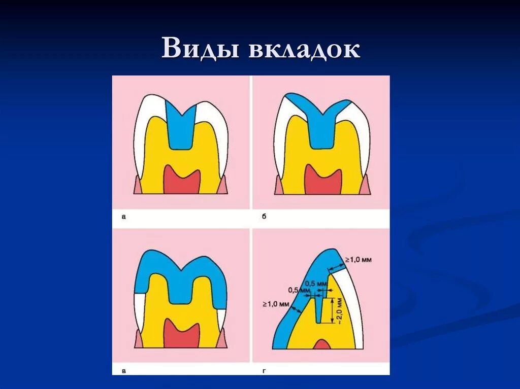 Вкладки изображения. Вкладки ортопедическая стоматология Инлей. Inlay onlay Overlay pinlay вкладки. Вкладки стоматология классификация. Виды вкладок.