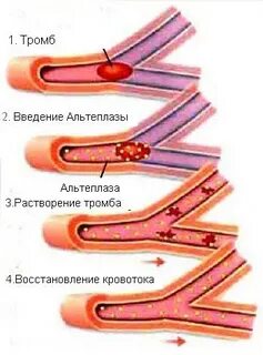 Как чистить тромбы