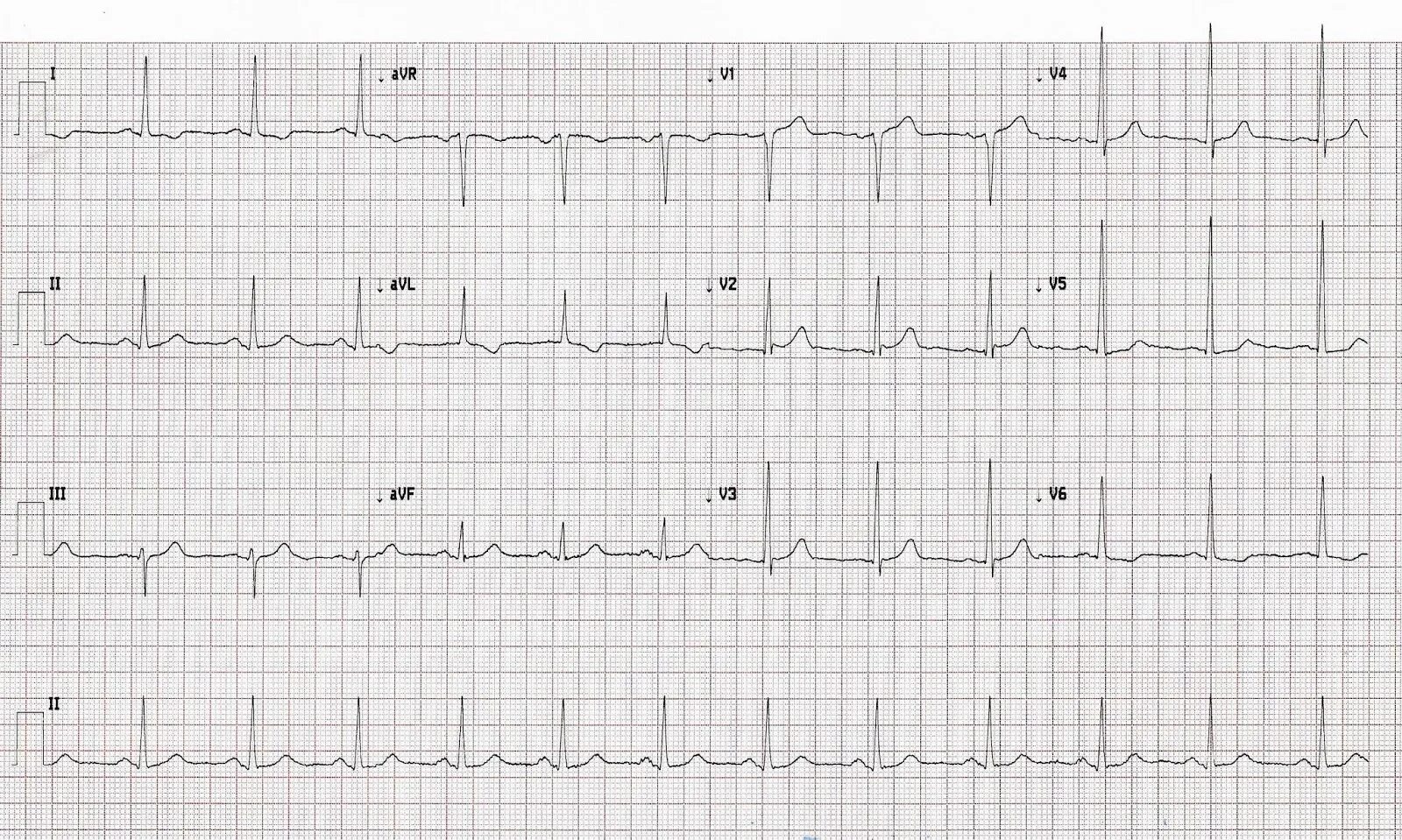 ЭКГ норма в 12 отведениях. Нормальное ЭКГ 25 мм. Норма ЭКГ кардиограмма. AVR ЭКГ норма и патология. Тяжелое экг