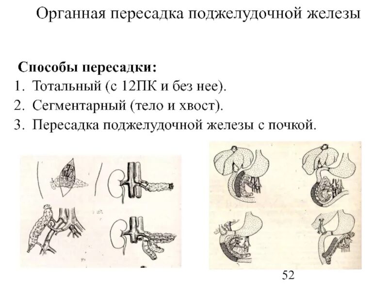 Трансплантация эндокринных желез. Трансплантация клеток поджелудочной железы. Трансплантация поджелудочной железы при сахарном диабете. Органная трансплантация поджелудочной железы. Пересадка поджелудочной железы при сахарном