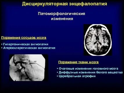 Дисциркуляторная энцефалопатия головного