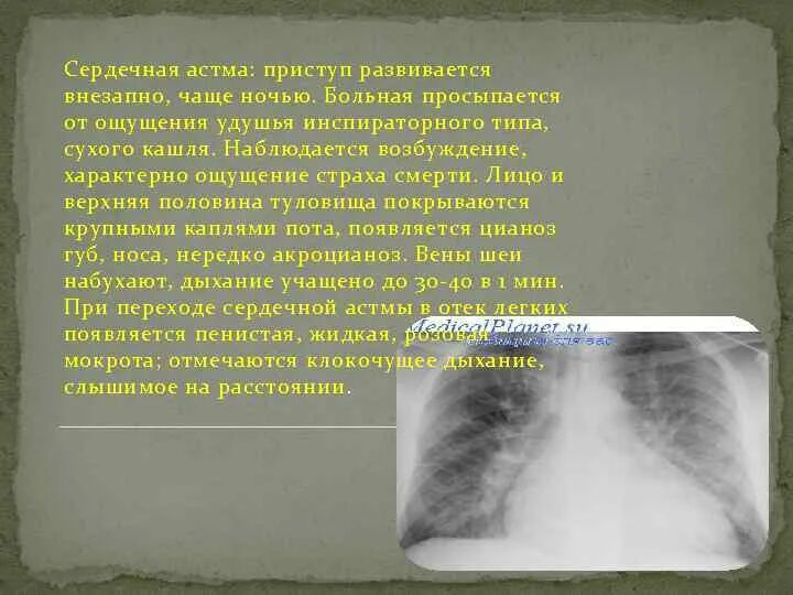 Астма ночью. Сердечная астма пропедевтика. сердечная астма рентген. ощущение страха смерти характерно. чувство страха смерти при сердечной астме.