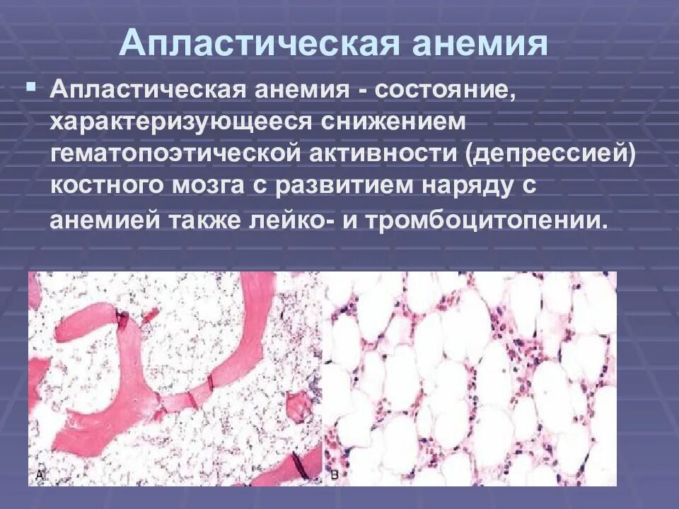 Апластическая анемия это. Апластическая анемия это