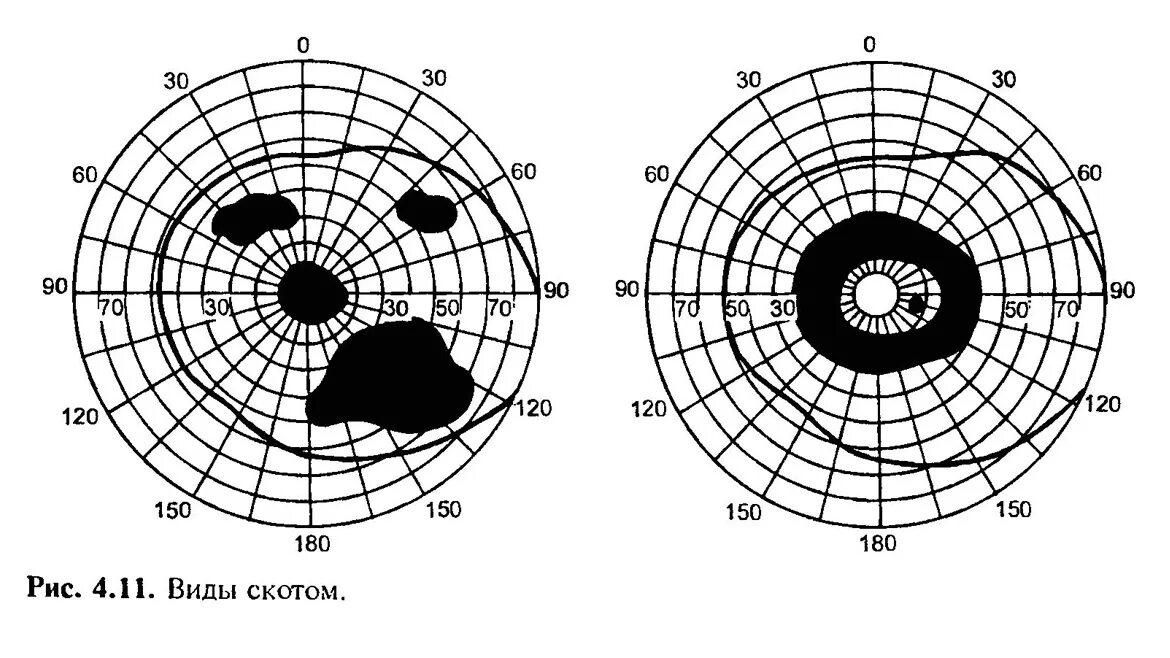 Центральные скотомы в поле зрения. Периметрия скотомы. Центральная скотома периметрия. Периметрия Центральная Относительная скотома. Центральное поле зрения