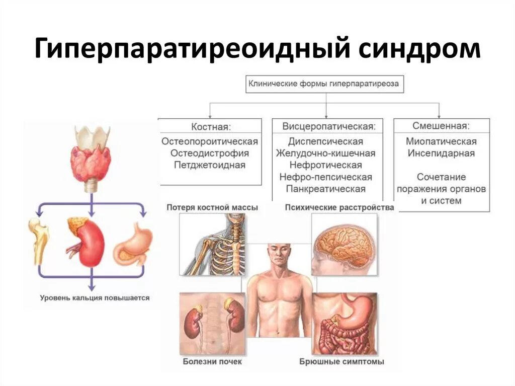 Лечение гиперпаратиреоза у женщин. Третичный гиперпаратиреоз патогенез. Первичный гиперпаратиреоз патогенез. Симптомы гиперпаратиреоза. Этиология гиперпаратиреоза.