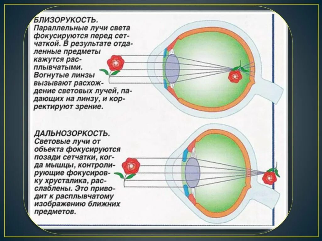 Минус и плюс в зрении. Дальнозоркость и близорукость строение глаза. Миопия схема глаза. Строение хрусталика при близорукости. Нарушение зрения близорукость дальнозоркость.