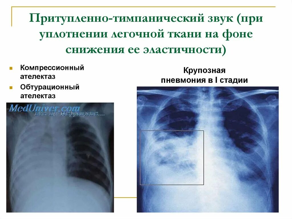 Уплотнение в легких что это