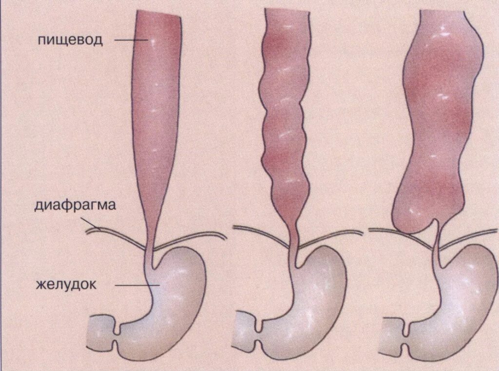 Ахалазия кардии и кардиоспазм. Пищевода заболевания ахалазия кардии. Ахалазия кардии симптомы. Симптомы ахалазии кардии. Несмыкание кардии желудка