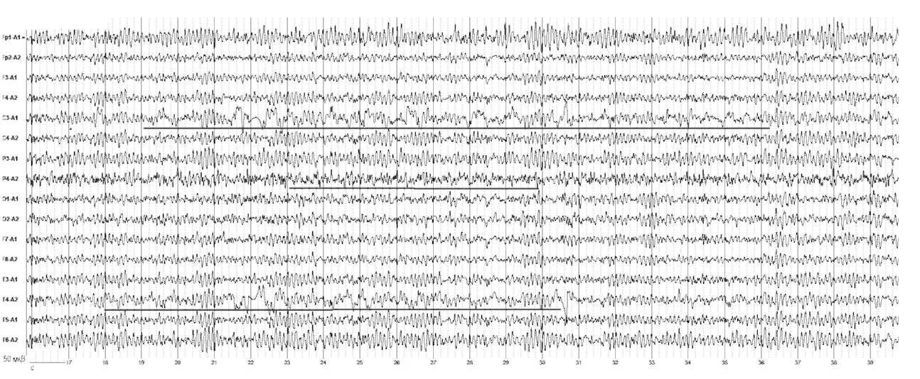 Альфа ритм ЭЭГ. Височная эпилепсия на ЭЭГ. Электроэнцефалография физиология. Дезорганизованная Альфа-активность на ЭЭГ. Ээг изменения биоэлектрической активности