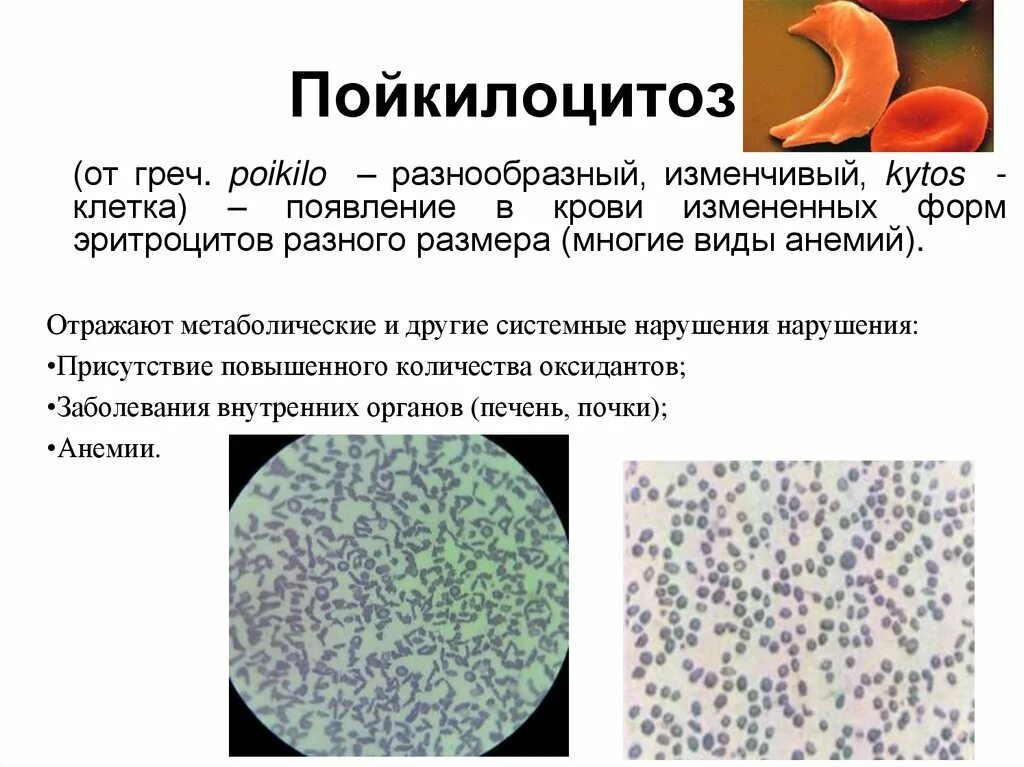 Пойкилоцитоз анемия. Пойкилоцитоз эритроцитов. Анизоцитоз и пойкилоцитоз. Пойкилоцитоз виды. Патологические формы эритроцитов пойкилоцитоз.