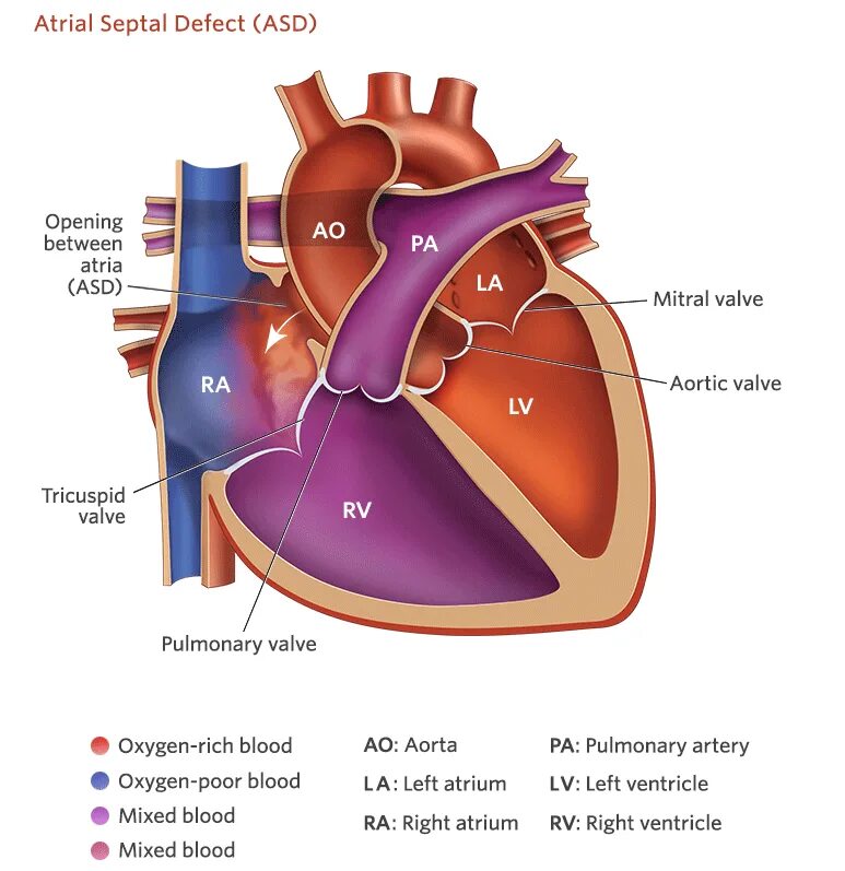 Врожденные пороки сердца дефект межпредсердной перегородки. Atrial septal defect (asd). овальное окно в сердце. порок сердца открытое овальное окно. asd межжелудочковой перегородки.