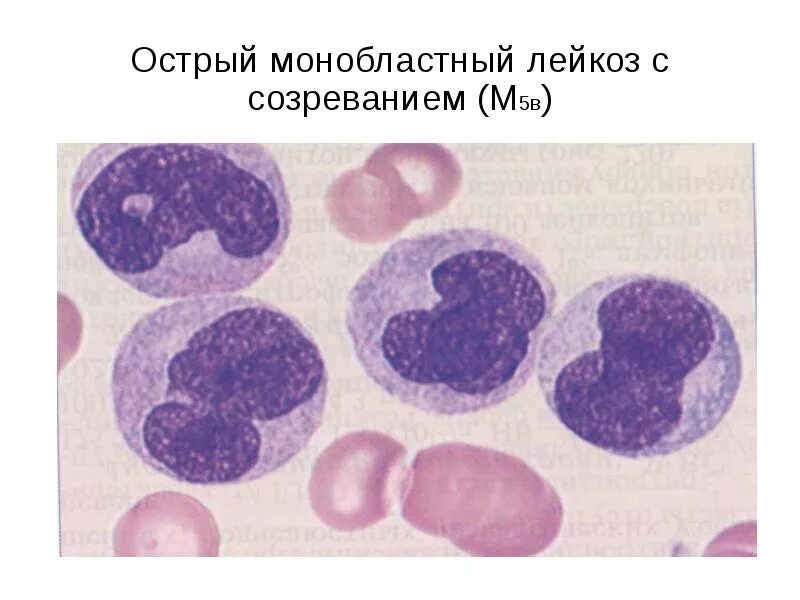 Лейкоз обострение. Острый монобластный (миеломонобластный) лейкоз. острый миелоидный лейкоз кровь.