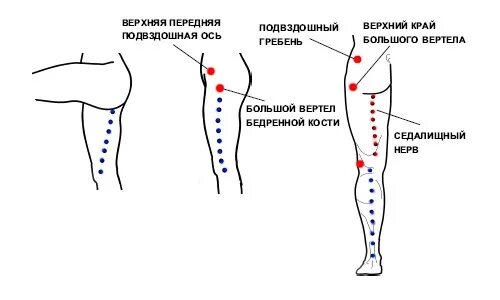 Седалищный нерв точки воздействия массаж точечный. Ишиас седалищного нерва точечный массаж. Точечный массаж при защемлении седалищного нерва ишиасе. Акупрессура седалищный нерв.