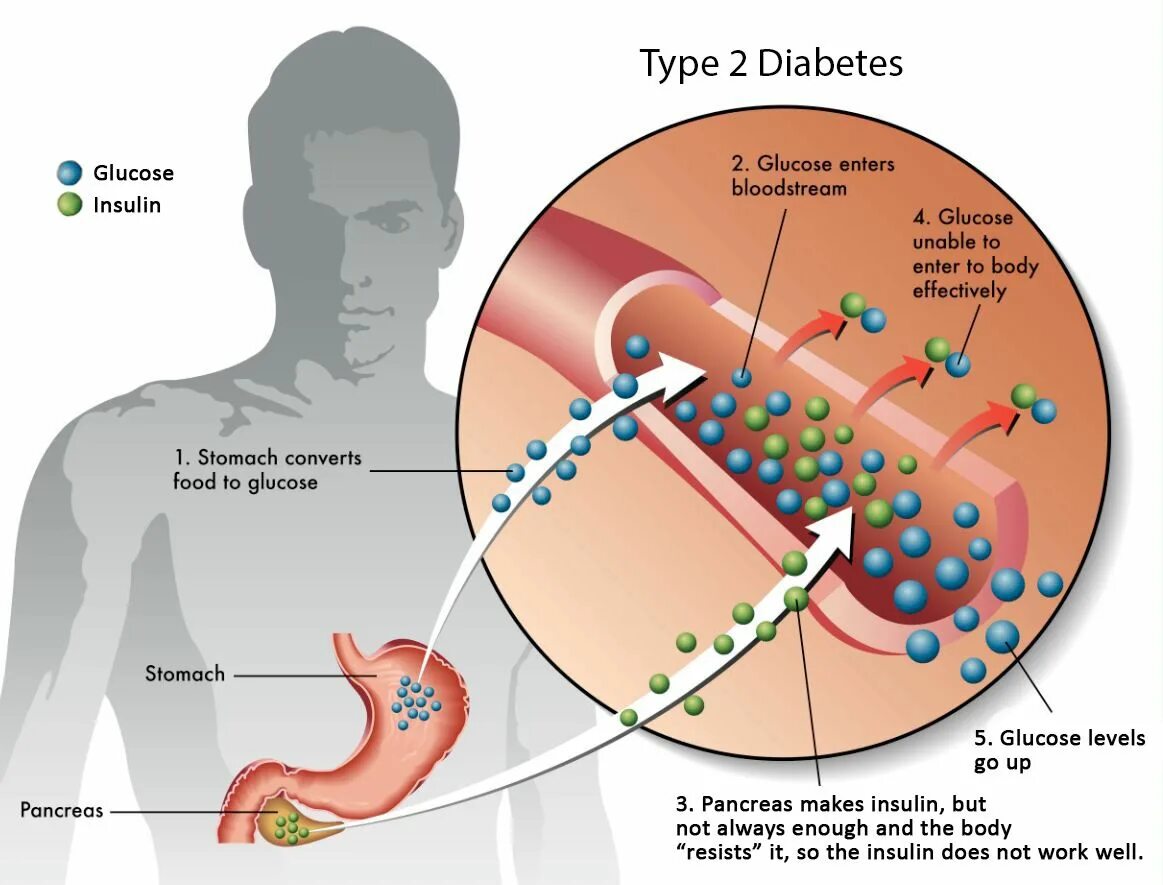 Сахарный диабет 1-го типа. Сахарный диабет 2-го типа. Типы сахарного диабета 1 типа. Инсулинорезистентность клетки. Регистр сахарного диабета 2024