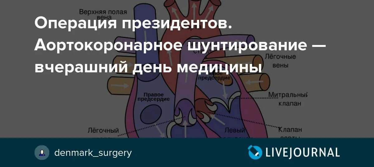 Шунтирование сердца операция сколько по времени. Шунтирование сердца операция сколько по времени